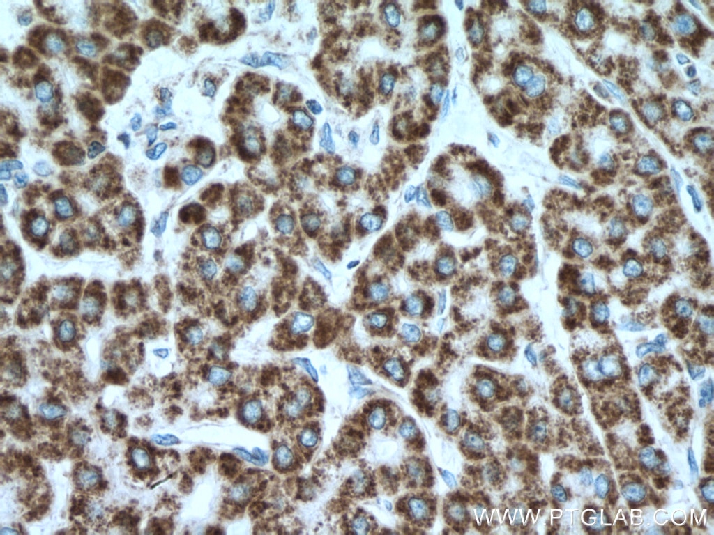 Immunohistochemistry (IHC) staining of human liver cancer tissue using IVD Monoclonal antibody (66032-1-Ig)