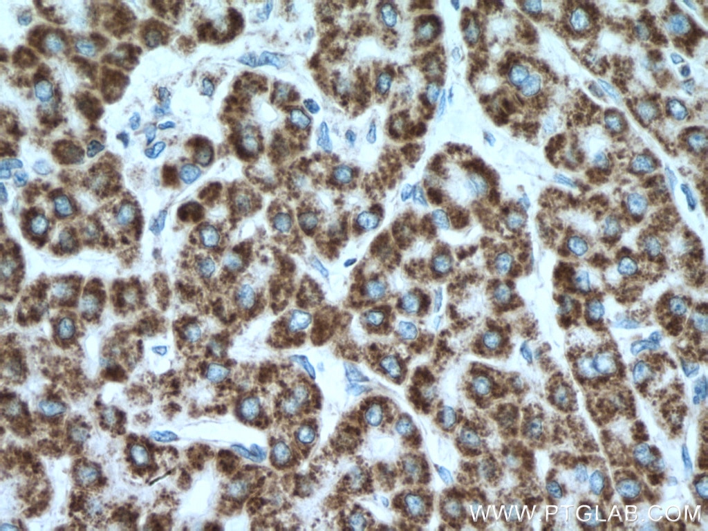 IHC staining of human liver cancer using 66032-1-Ig