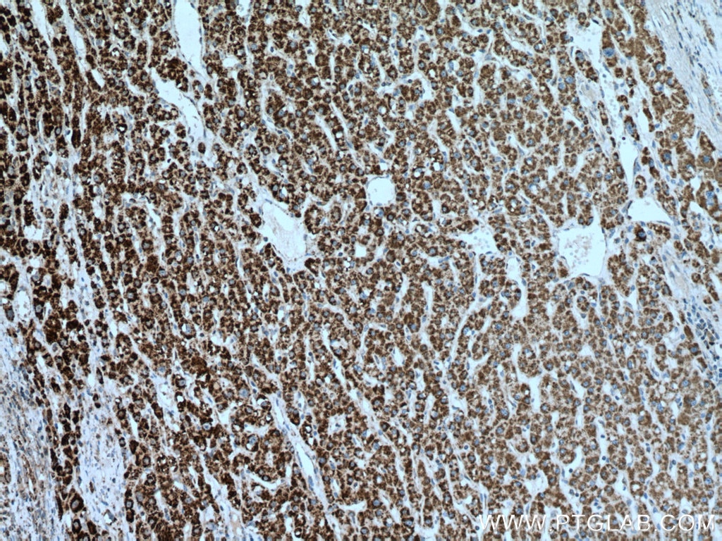 Immunohistochemistry (IHC) staining of human liver cancer tissue using IVD Monoclonal antibody (66032-1-Ig)