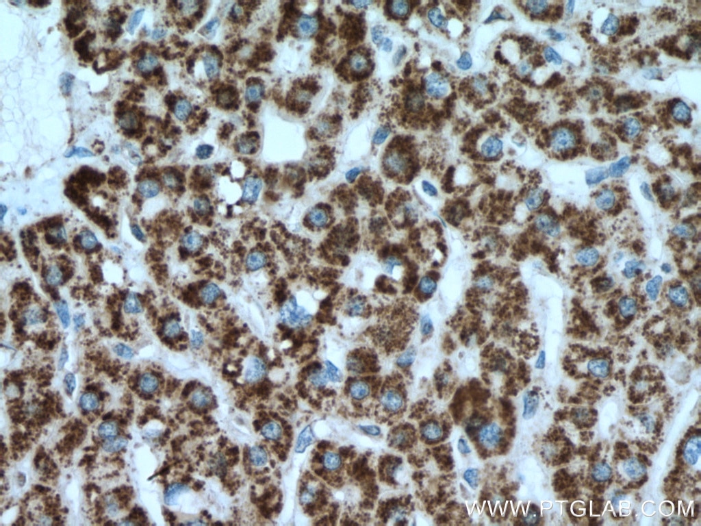 Immunohistochemistry (IHC) staining of human liver cancer tissue using IVD Monoclonal antibody (66032-1-Ig)