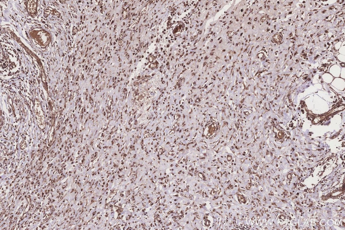 Immunohistochemistry (IHC) staining of human colon cancer tissue using IVD Monoclonal antibody (66032-1-Ig)
