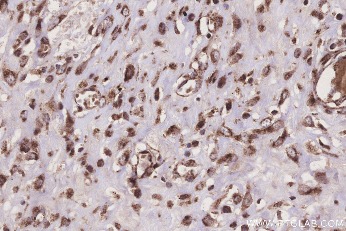 Immunohistochemistry (IHC) staining of human colon cancer tissue using IVD Monoclonal antibody (66032-1-Ig)