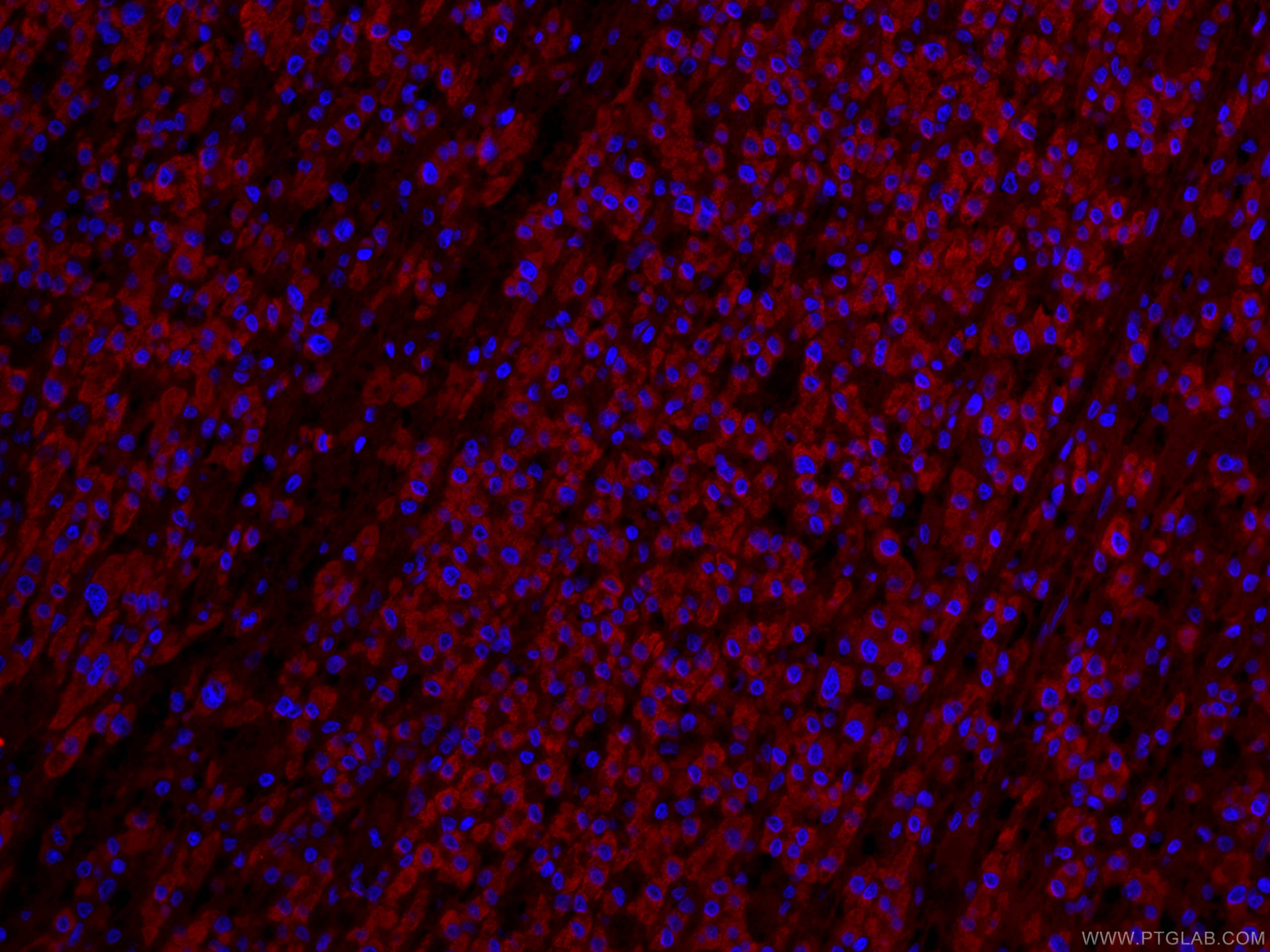 Immunofluorescence (IF) / fluorescent staining of human liver cancer tissue using CoraLite®594-conjugated IVD Monoclonal antibody (CL594-66032)