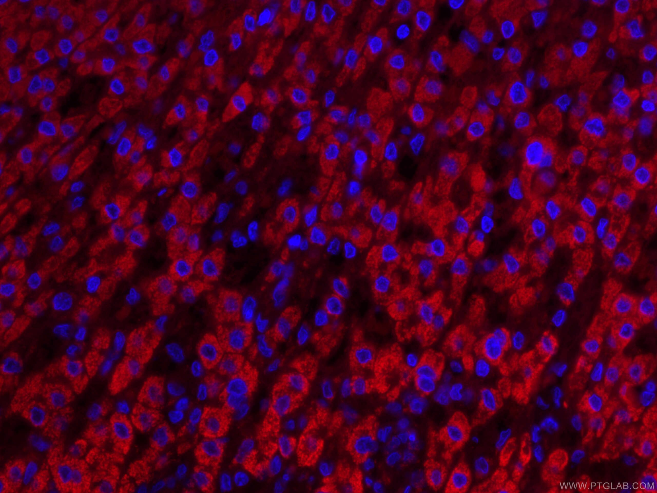 Immunofluorescence (IF) / fluorescent staining of human liver cancer tissue using CoraLite®594-conjugated IVD Monoclonal antibody (CL594-66032)