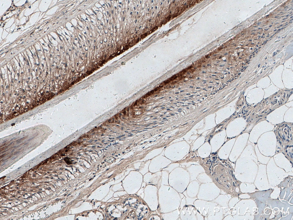 IHC staining of human skin cancer using 55328-1-AP