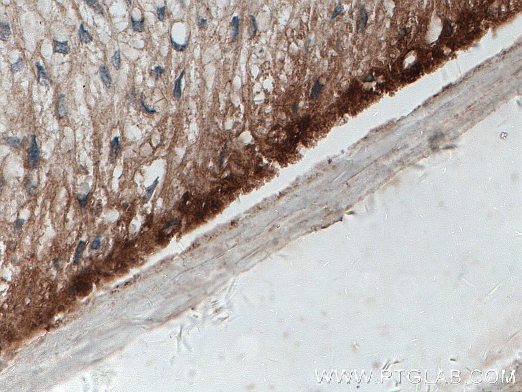 Immunohistochemistry (IHC) staining of human skin cancer tissue using Involucrin Polyclonal antibody (55328-1-AP)