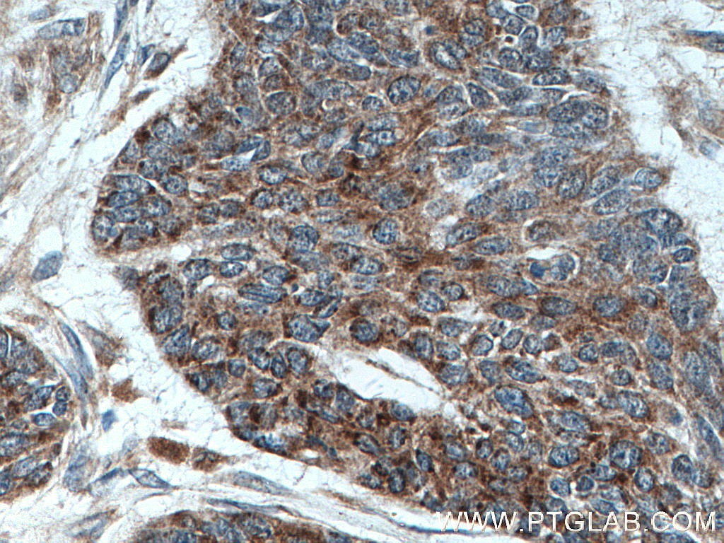 IHC staining of human skin cancer using 55328-1-AP