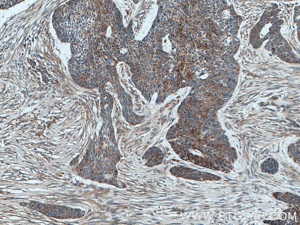 IHC staining of human skin cancer using 55328-1-AP