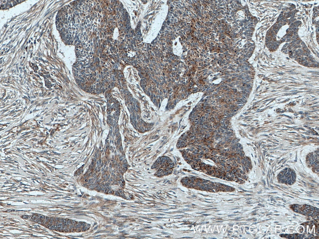 Immunohistochemistry (IHC) staining of human skin cancer tissue using Involucrin Polyclonal antibody (55328-1-AP)