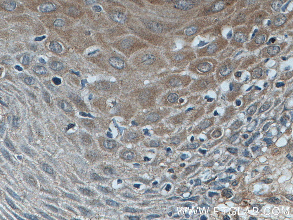 Immunohistochemistry (IHC) staining of human skin cancer tissue using Involucrin Polyclonal antibody (55328-1-AP)