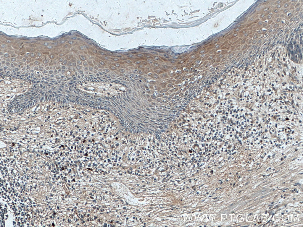 Immunohistochemistry (IHC) staining of human skin cancer tissue using Involucrin Polyclonal antibody (55328-1-AP)