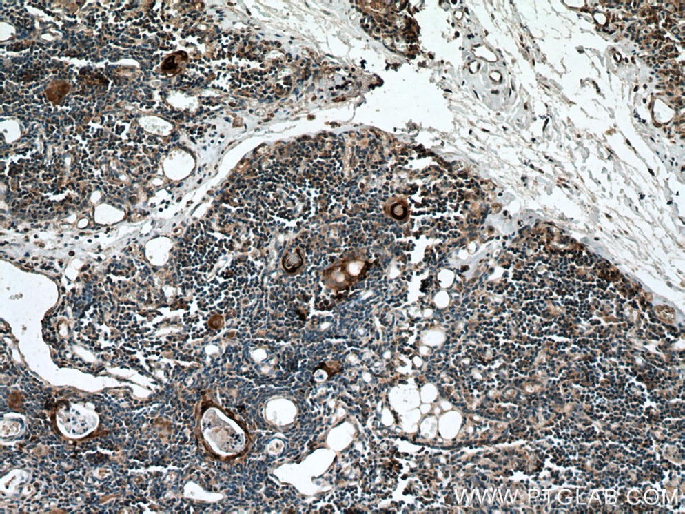 Immunohistochemistry (IHC) staining of human thymus tissue using Involucrin Polyclonal antibody (55328-1-AP)