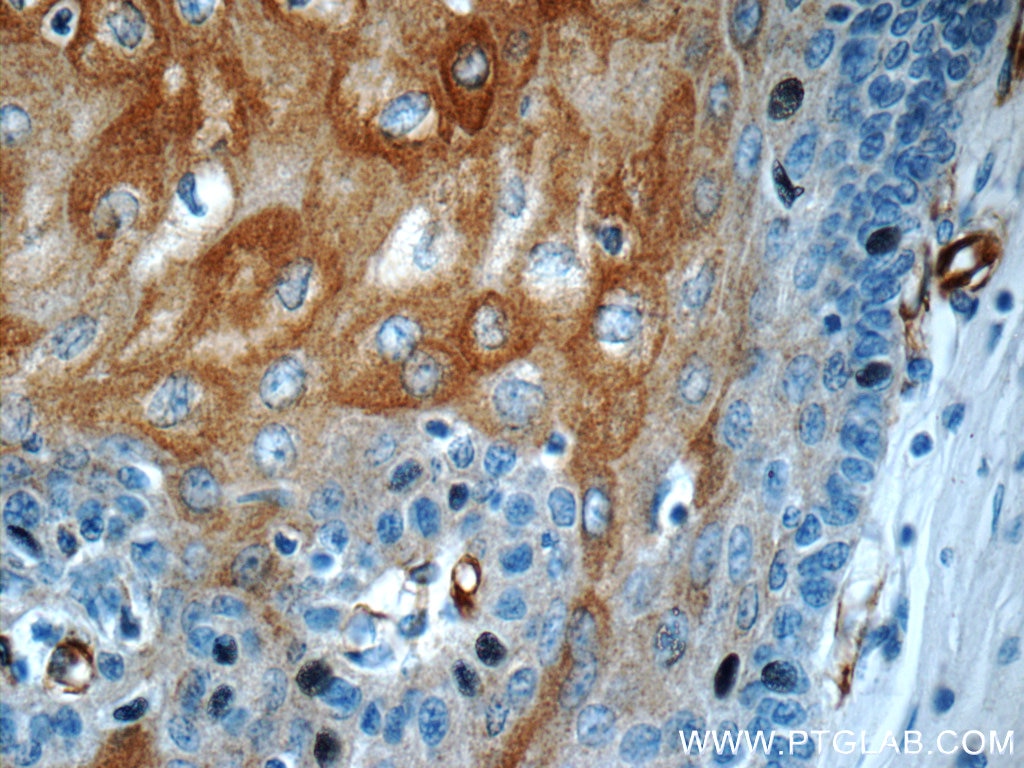 Immunohistochemistry (IHC) staining of human oesophagus tissue using Involucrin Polyclonal antibody (55328-1-AP)