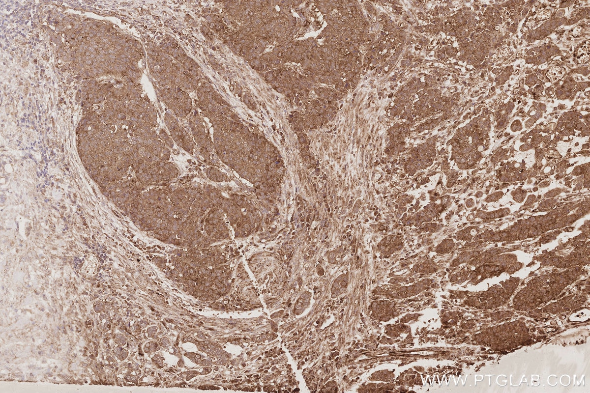 IHC staining of human stomach cancer using 84268-1-RR Immunohistochemistry (IHC) staining of human stomach cancer tissue using IVNS1ABP Recombinant monoclonal antibody (84268-1-RR)