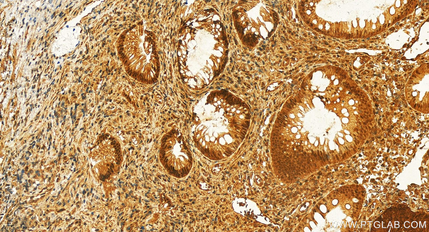 Immunohistochemical analysis of paraffin-embedded human colon cancer slide using 25964-1-AP (Icln antibody) at dilution of 1:200 (under 20x lens). Heat mediated antigen retrieval with Tris-EDTA buffer (pH 9.0). Immunohistochemistry (IHC) staining of human colon cancer using Icln Polyclonal antibody (25964-1-AP)