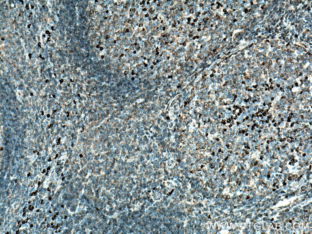 Immunohistochemistry (IHC) staining of human tonsillitis tissue using Human IgG Lambda Light Chain Polyclonal antibody (20758-1-AP)