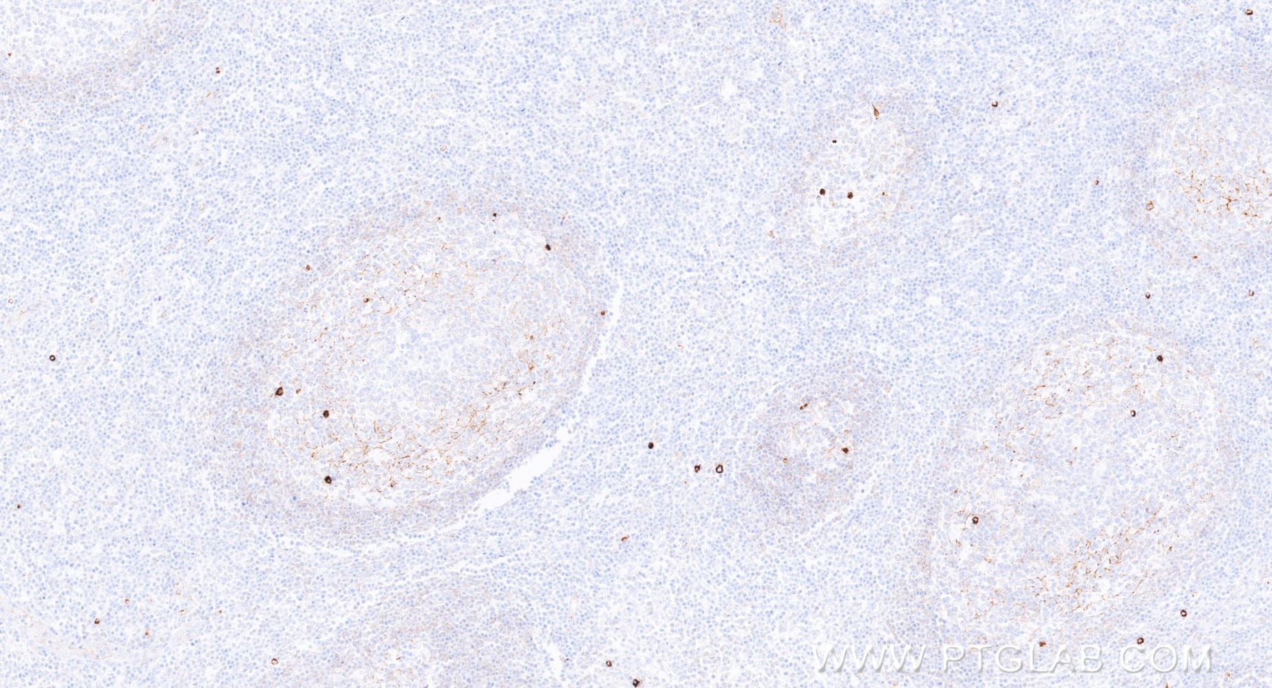 IHC staining of human tonsillitis using 98744-1-RR Immunohistochemistry (IHC) staining of human tonsillitis tissue using Anti-Human IgM Rabbit Recombinant Antibody (98744-1-RR)