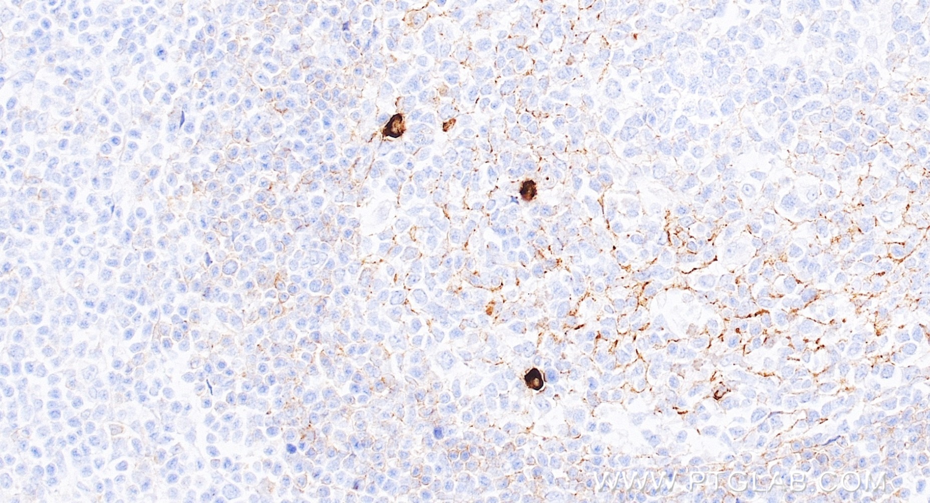 IHC staining of human tonsillitis using 98744-1-RR Immunohistochemistry (IHC) staining of human tonsillitis tissue using Anti-Human IgM Rabbit Recombinant Antibody (98744-1-RR)