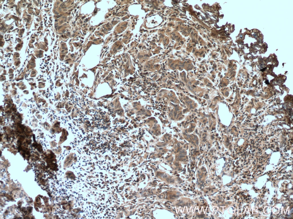 Immunohistochemistry (IHC) staining of human prostate cancer tissue using IkB Alpha Monoclonal antibody (66418-1-Ig)