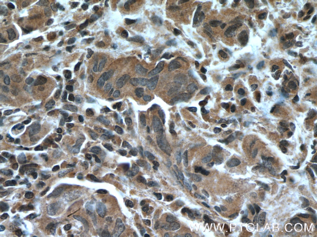 Immunohistochemistry (IHC) staining of human prostate cancer tissue using IkB Alpha Monoclonal antibody (66418-1-Ig)