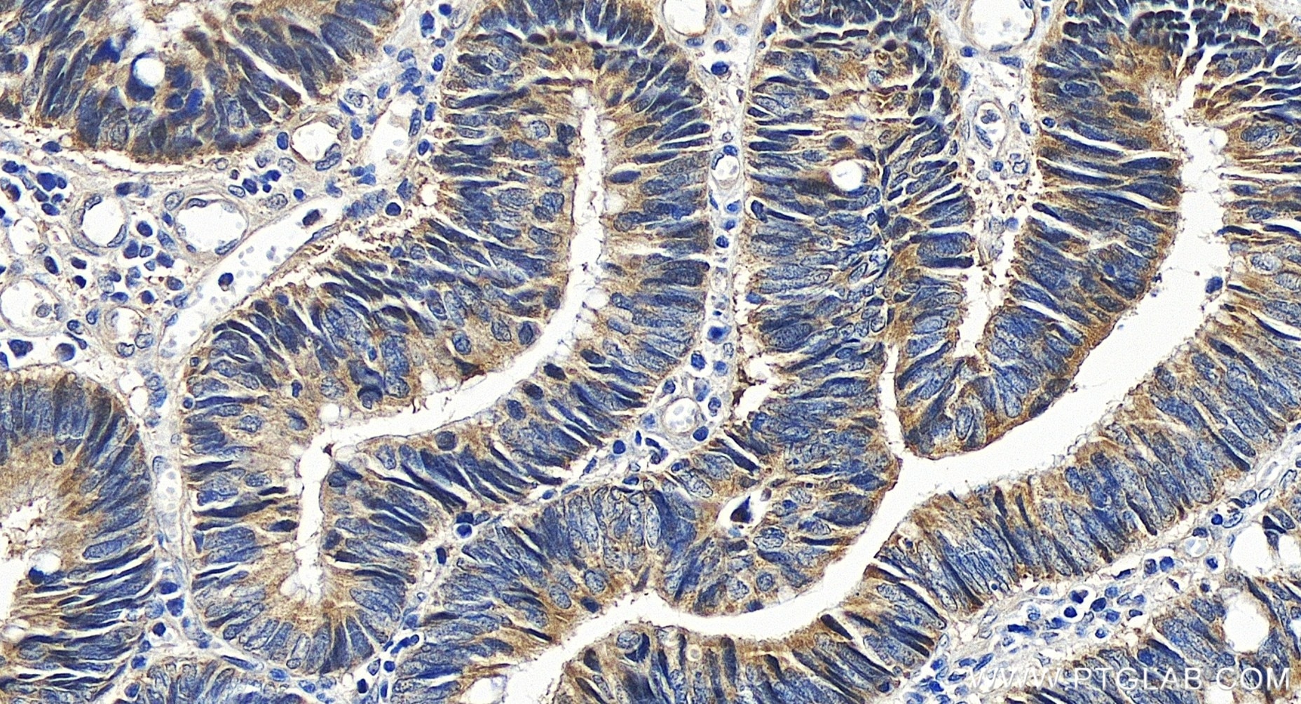 Immunohistochemistry (IHC) staining of human colon cancer tissue using IkB Alpha Recombinant antibody (80019-1-RR)