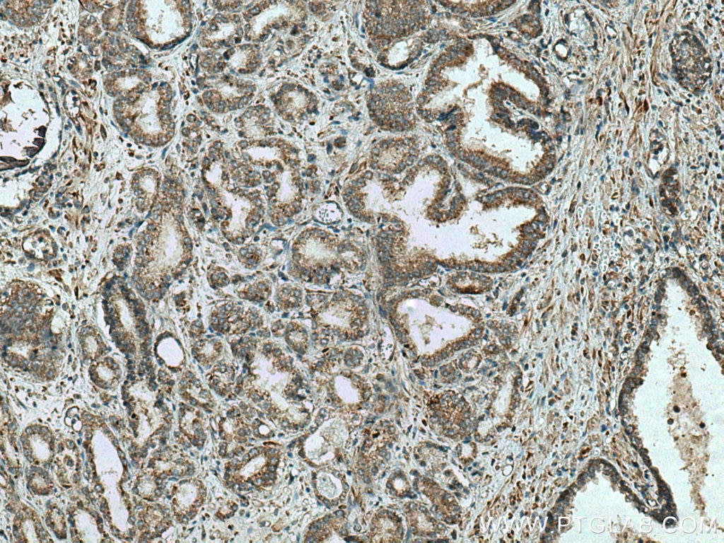 Immunohistochemistry (IHC) staining of human prostate cancer tissue using IkB Alpha Recombinant antibody (80019-1-RR)