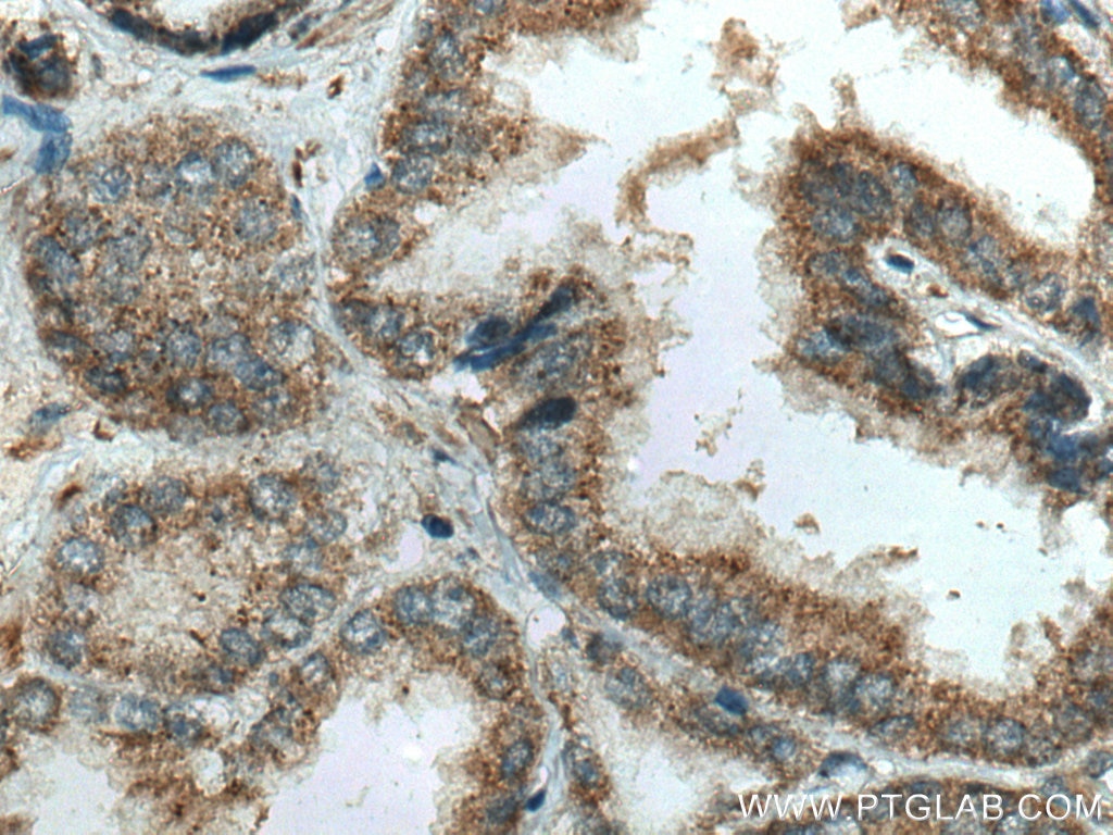 Immunohistochemistry (IHC) staining of human prostate cancer tissue using IkB Alpha Recombinant antibody (80019-1-RR)