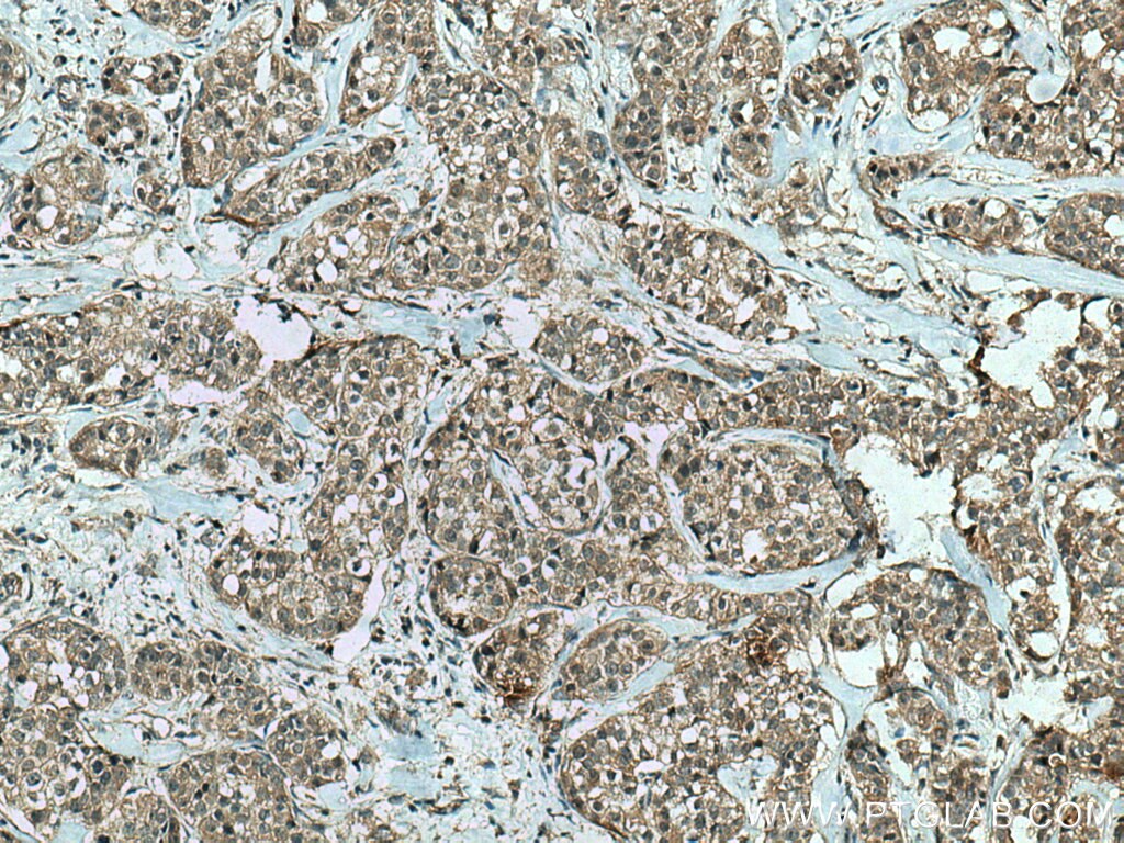 Immunohistochemistry (IHC) staining of human breast cancer tissue using IkB Alpha Recombinant antibody (80019-1-RR)