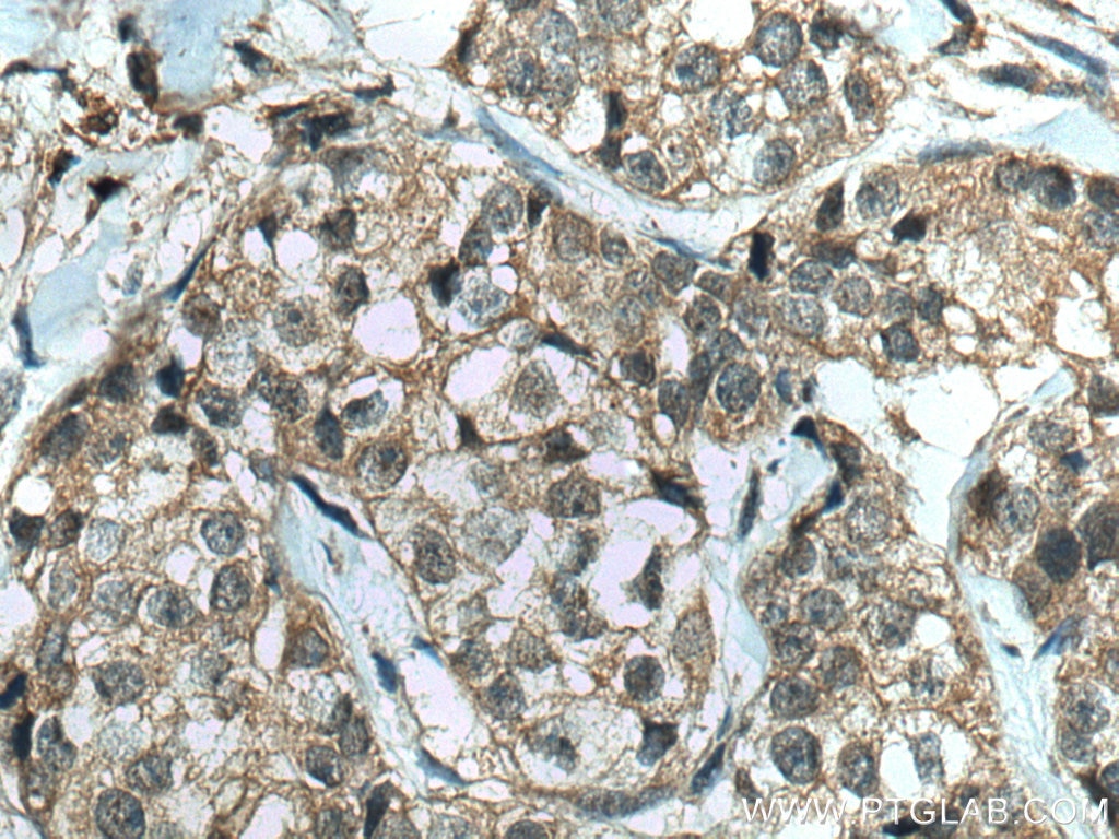 Immunohistochemistry (IHC) staining of human breast cancer tissue using IkB Alpha Recombinant antibody (80019-1-RR)