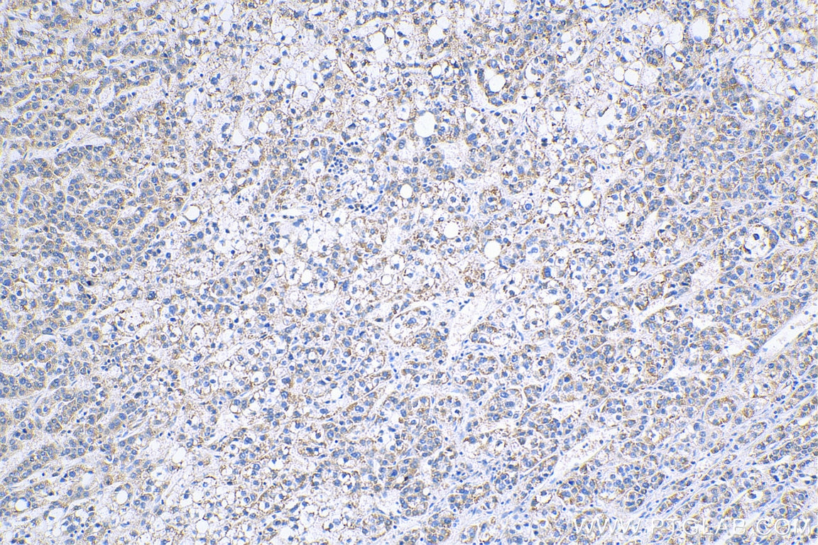 Immunohistochemistry (IHC) staining of human liver cancer tissue using IL-17a Polyclonal antibody (26163-1-AP)