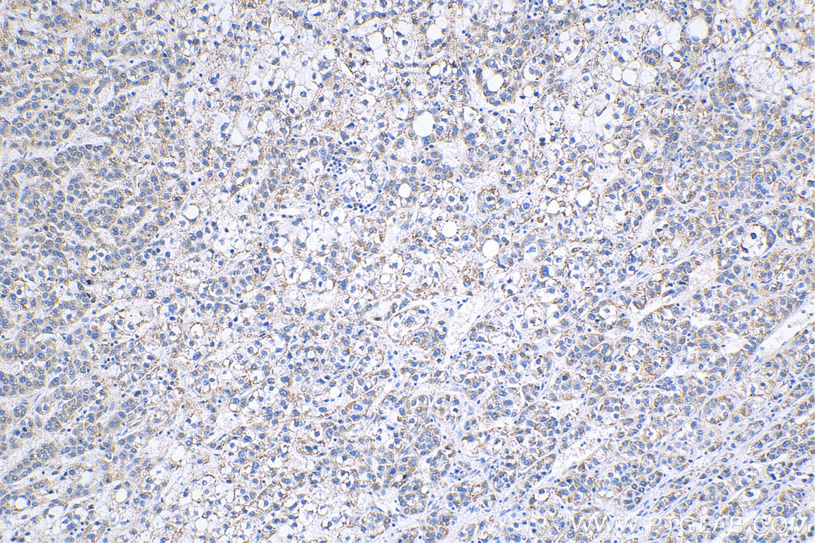 IHC staining of human liver cancer using 26163-1-AP