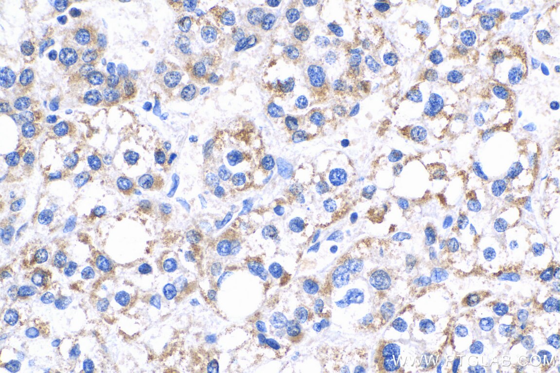 Immunohistochemistry (IHC) staining of human liver cancer tissue using IL-17a Polyclonal antibody (26163-1-AP)
