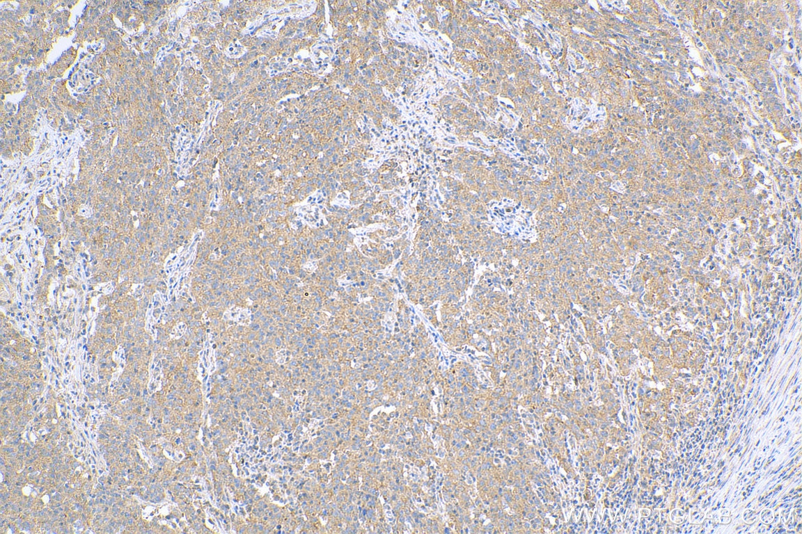 Immunohistochemistry (IHC) staining of human stomach cancer tissue using IL-17a Polyclonal antibody (26163-1-AP)