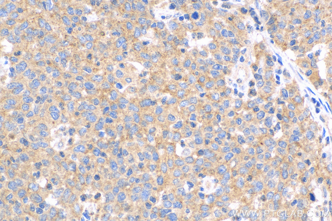 Immunohistochemistry (IHC) staining of human stomach cancer tissue using IL-17a Polyclonal antibody (26163-1-AP)