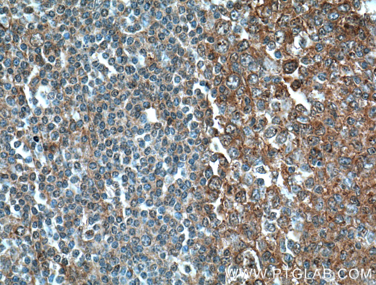 Immunohistochemistry (IHC) staining of human tonsillitis tissue using IL-2 Polyclonal antibody (26156-1-AP)