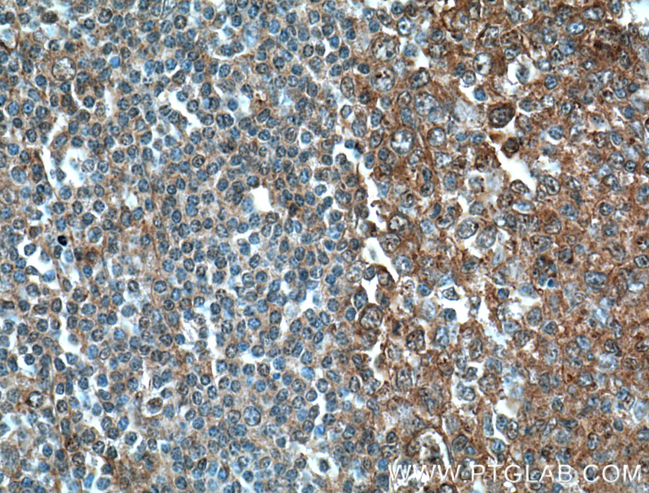 IHC staining of human tonsillitis using 26156-1-AP