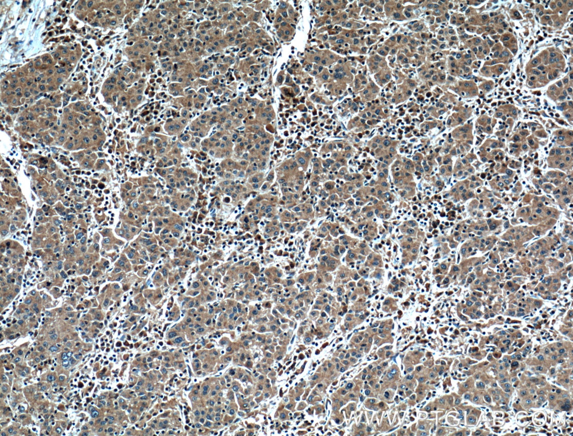 Immunohistochemistry (IHC) staining of human liver cancer tissue using IL-2 Polyclonal antibody (26156-1-AP)