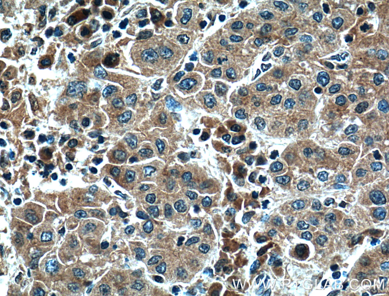 Immunohistochemistry (IHC) staining of human liver cancer tissue using IL-2 Polyclonal antibody (26156-1-AP)