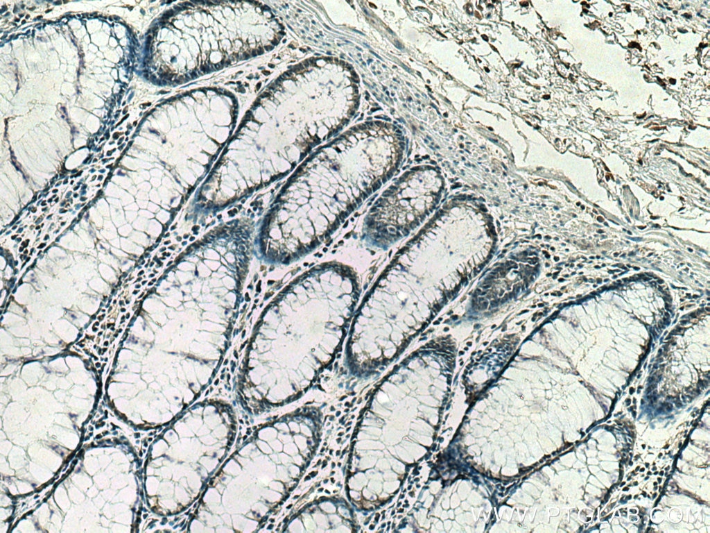 Immunohistochemistry (IHC) staining of human colon cancer tissue using Importin Beta Monoclonal antibody (67597-1-Ig)