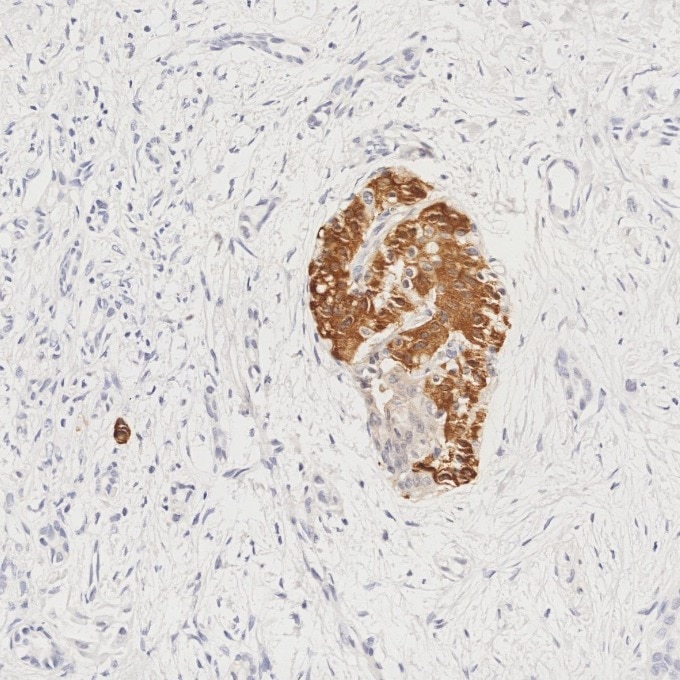 IHC staining of human pancreas cancer using 66198-1-Ig Immunohistochemistry (IHC) staining of human pancreas cancer tissue using INS Monoclonal antibody (66198-1-Ig)
