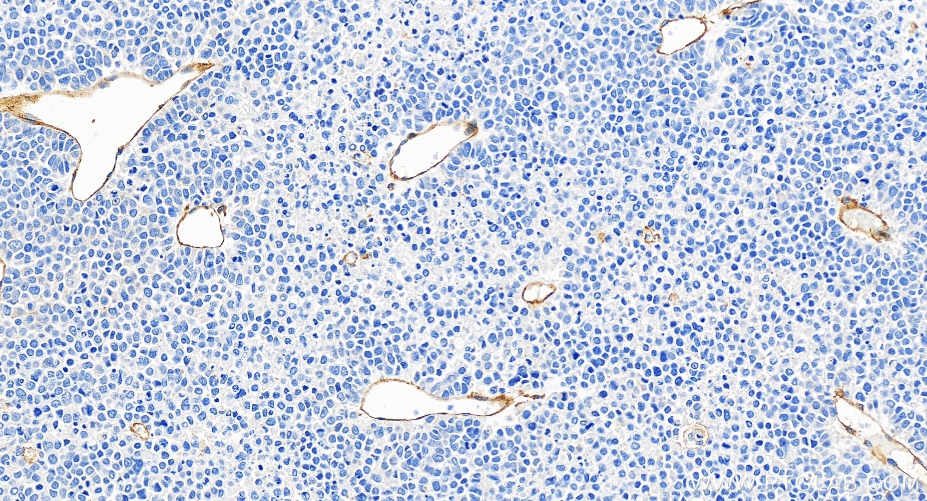 Immunohistochemistry (IHC) staining of human liver cancer tissue using Integrin Alpha V Recombinant monoclonal antibody (84883-5-RR)