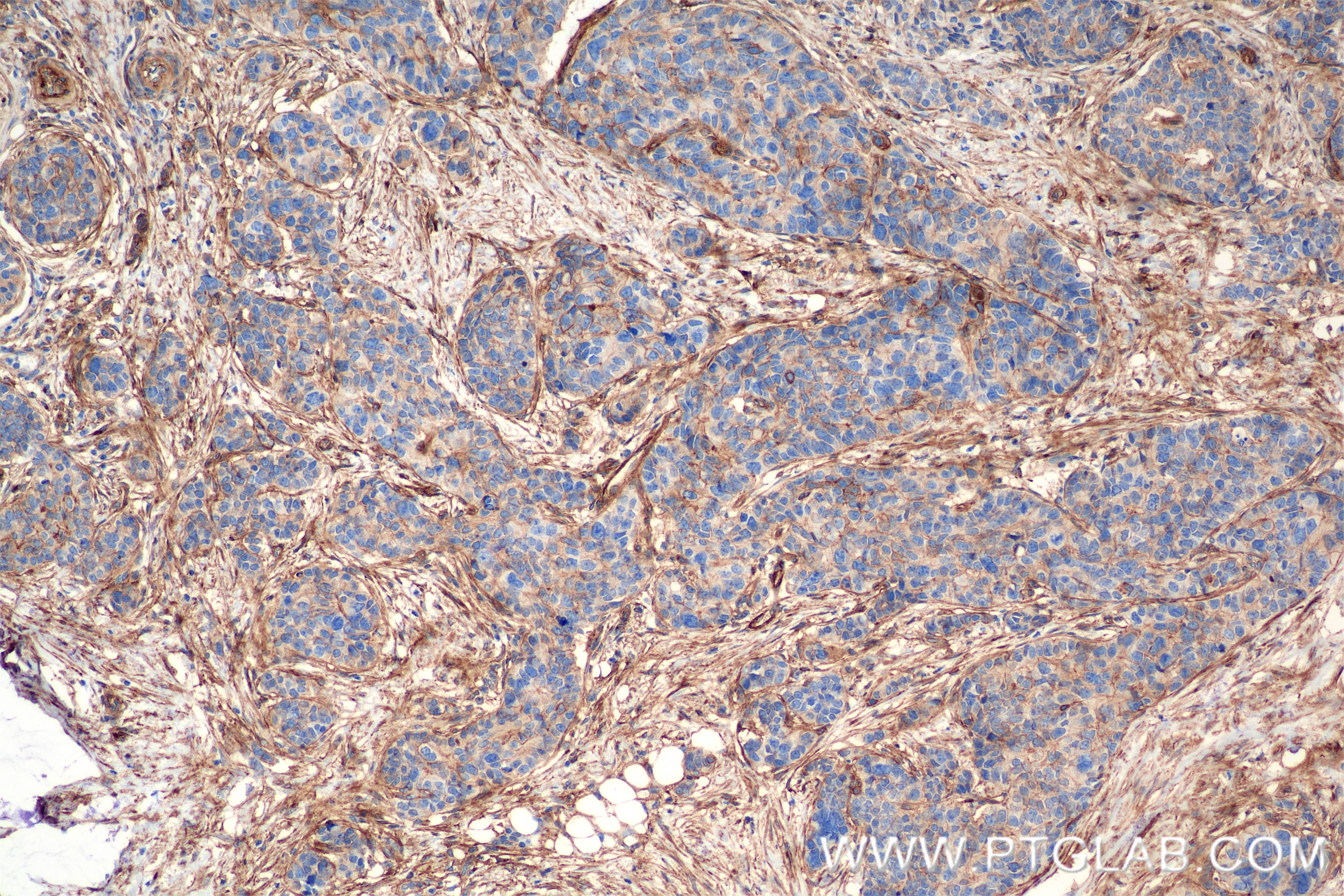 Immunohistochemistry (IHC) staining of human stomach cancer tissue using Integrin Alpha V Recombinant antibody (84883-5-RR)