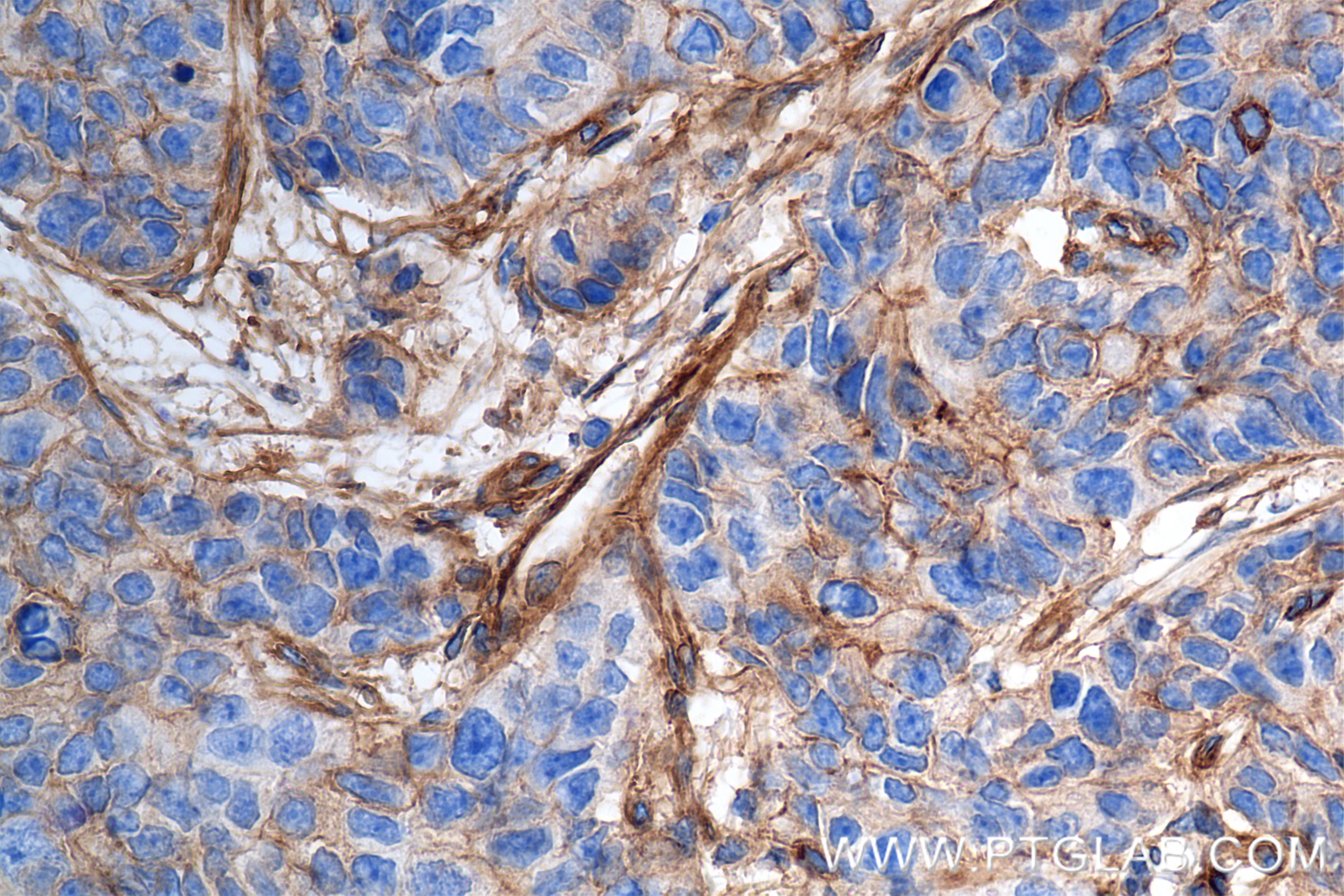 Immunohistochemistry (IHC) staining of human stomach cancer tissue using Integrin Alpha V Recombinant antibody (84883-5-RR)