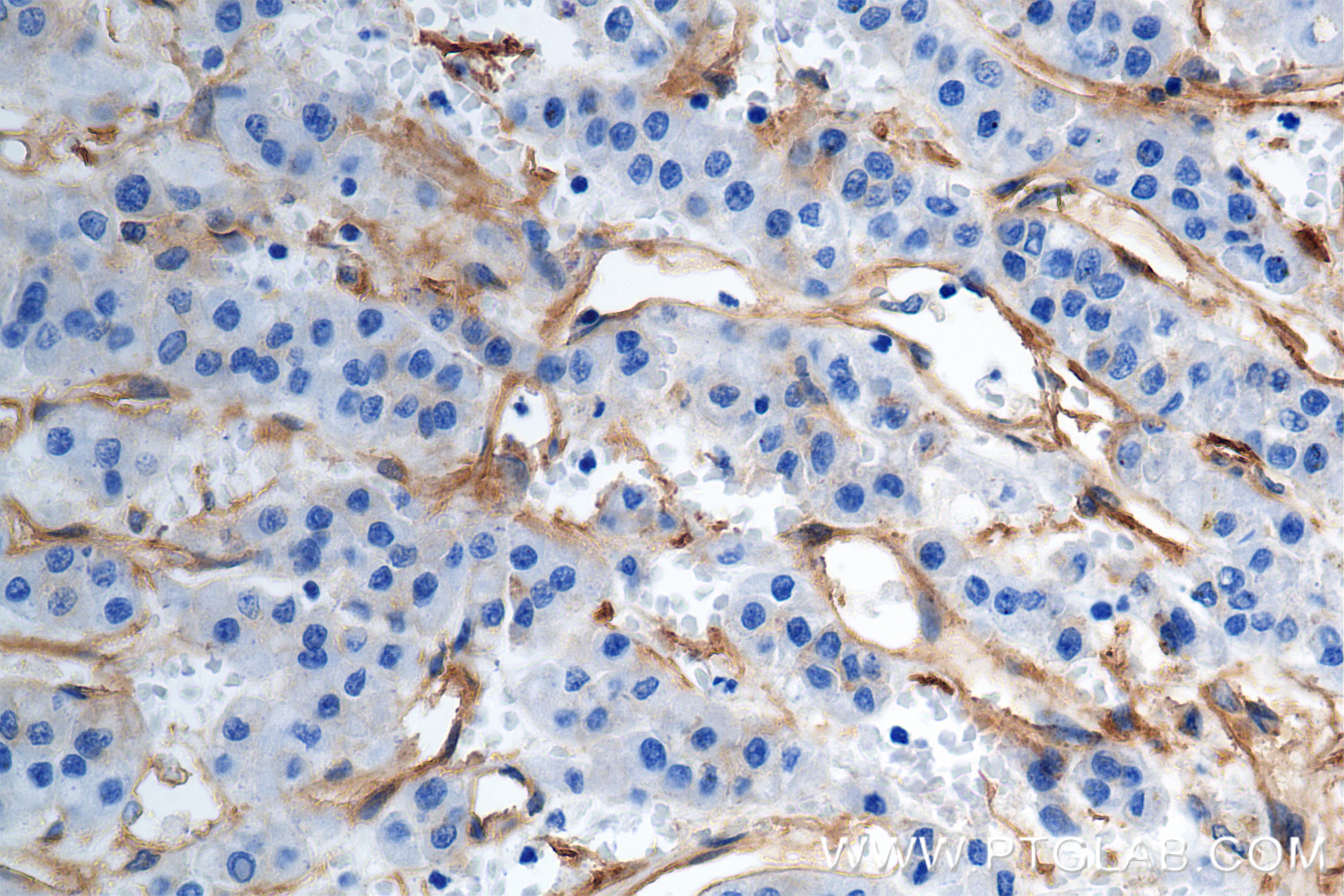 Immunohistochemistry (IHC) staining of human hepatocellular cancer using Integrin Alpha V Recombinant antibody (84883-5-RR)