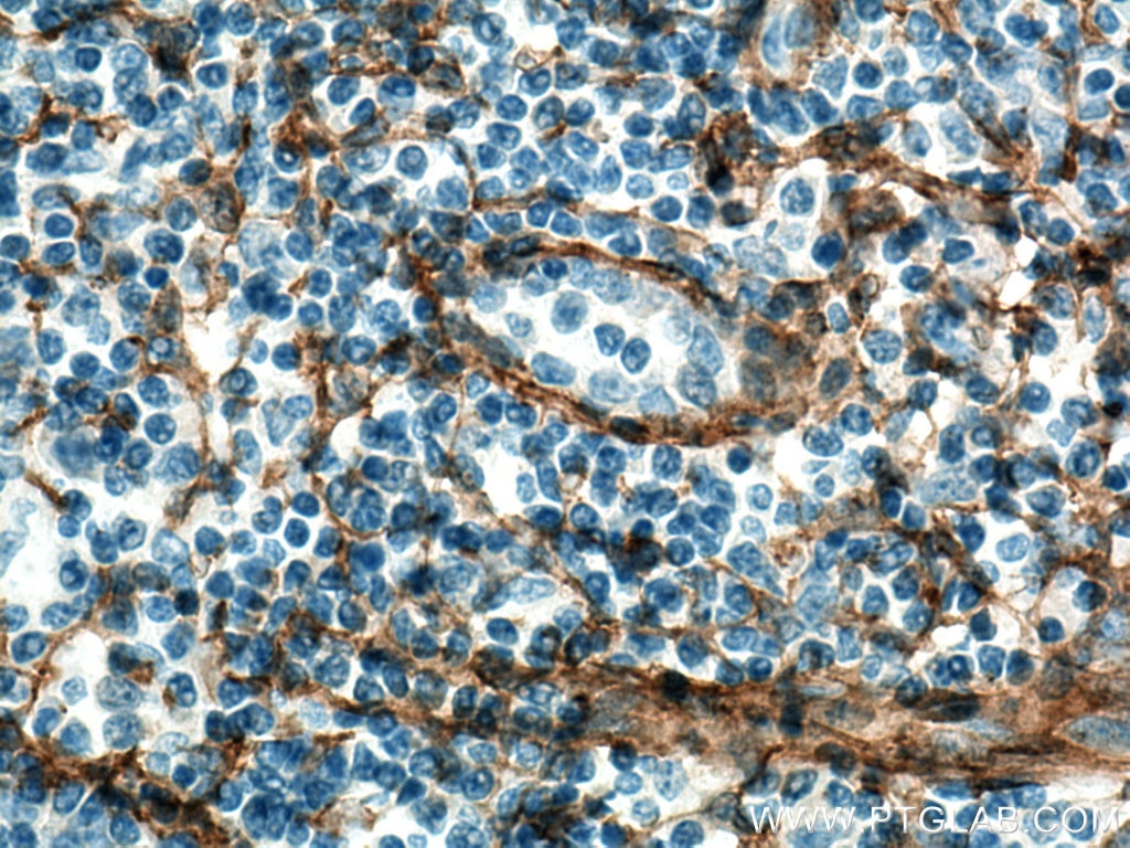 Immunohistochemistry (IHC) staining of human tonsillitis tissue using Integrin alpha-1 Polyclonal antibody (29042-1-AP)