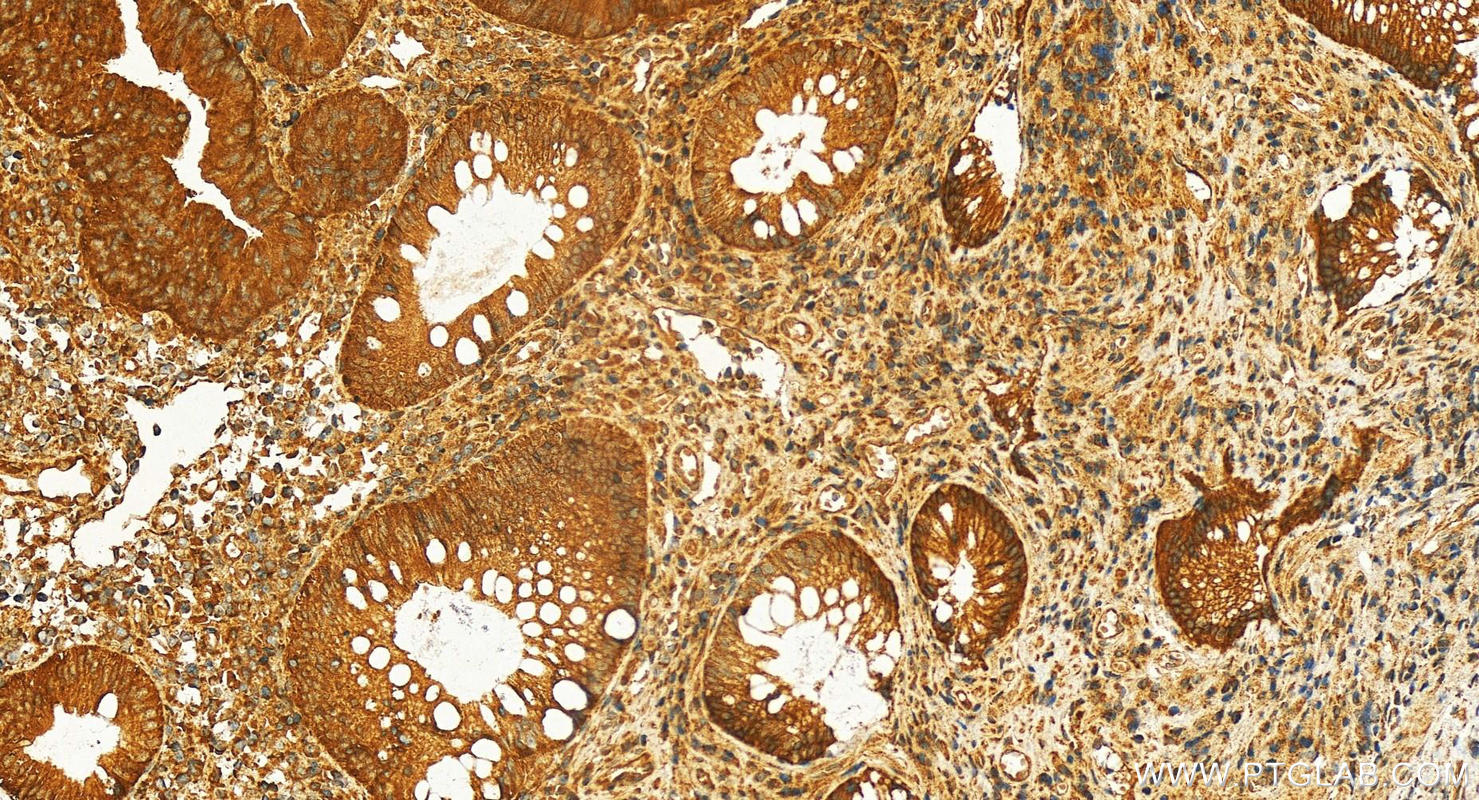 Immunohistochemistry (IHC) staining of human colon  cancer using CD49b Polyclonal antibody (30703-1-AP)
