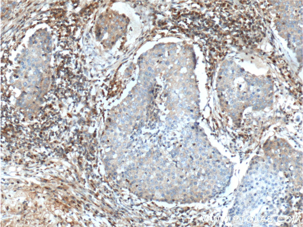 IHC staining of human lung cancer using 26918-1-AP