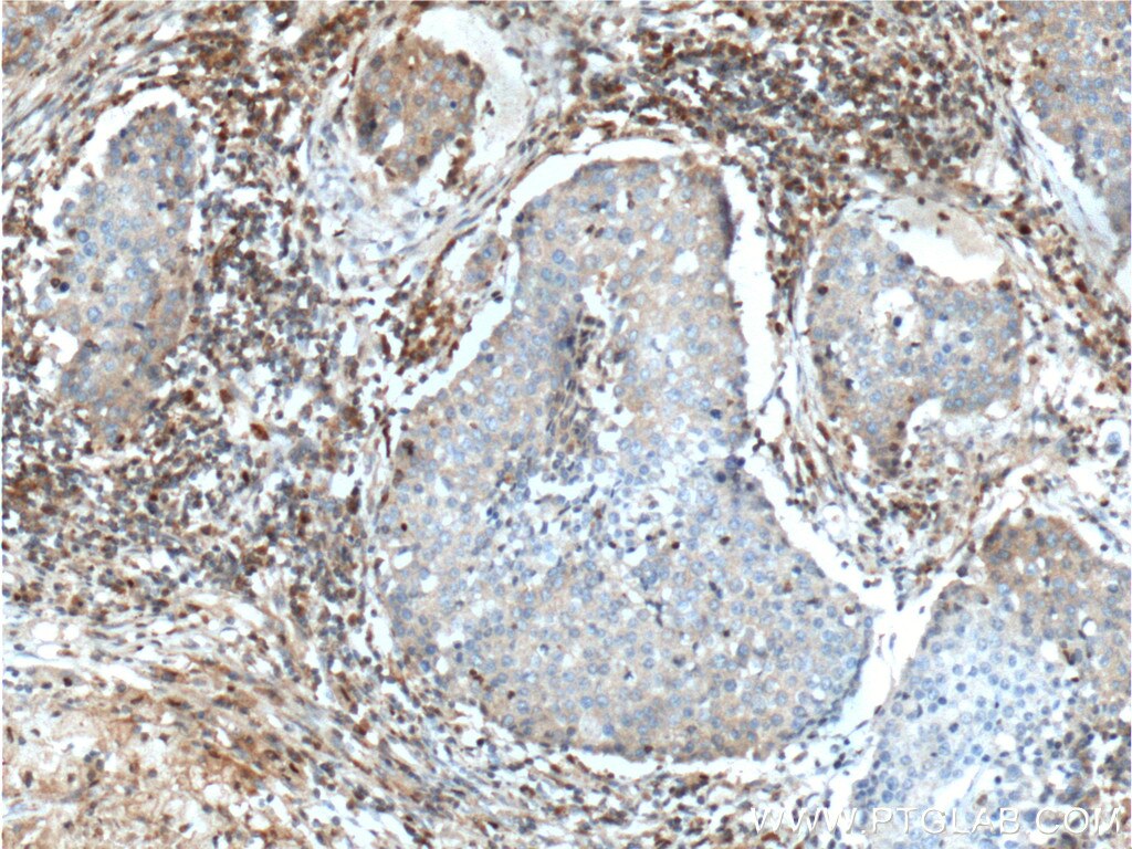 Immunohistochemistry (IHC) staining of human lung cancer tissue using Integrin Beta 1 Polyclonal antibody (26918-1-AP)