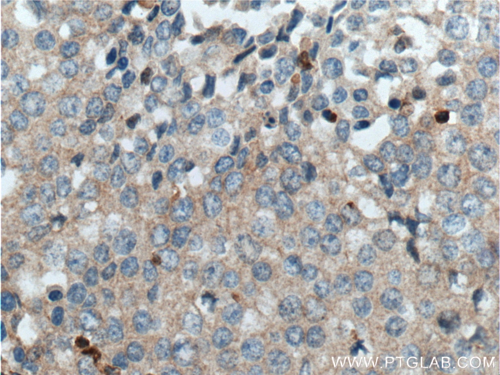 Immunohistochemistry (IHC) staining of human lung cancer tissue using Integrin Beta 1 Polyclonal antibody (26918-1-AP)