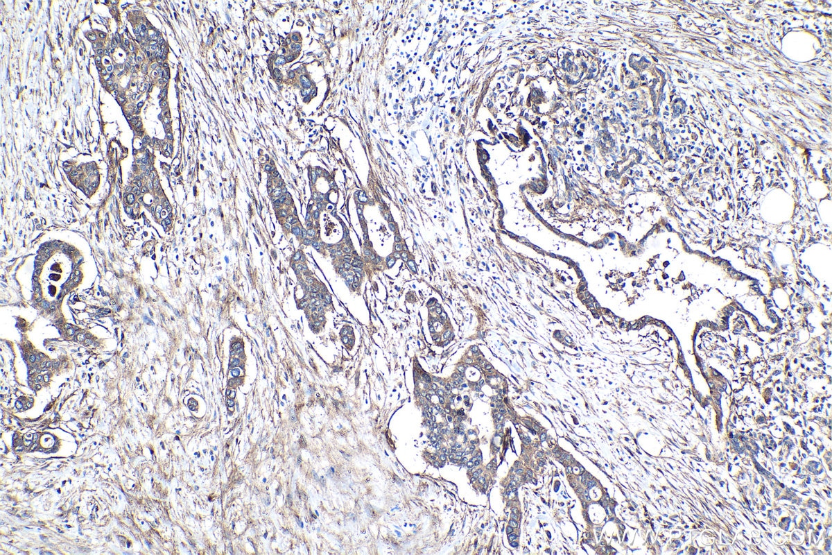 Immunohistochemistry (IHC) staining of human pancreas cancer tissue using Integrin Beta 5 Polyclonal antibody (28543-1-AP)